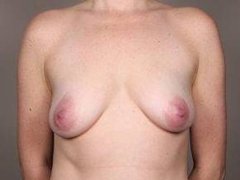 Breast Lift with Augmentation Before & After Gallery - Patient 215549 - Image 1 - Scott Chapin, MD
