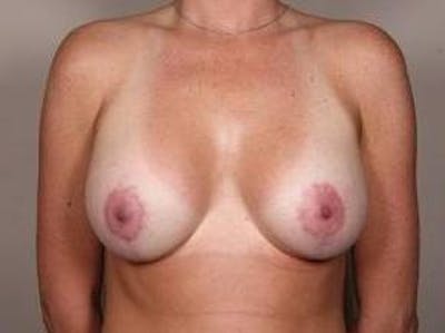 Breast Lift with Augmentation Before & After Gallery - Patient 215549 - Image 2 - Scott Chapin, MD