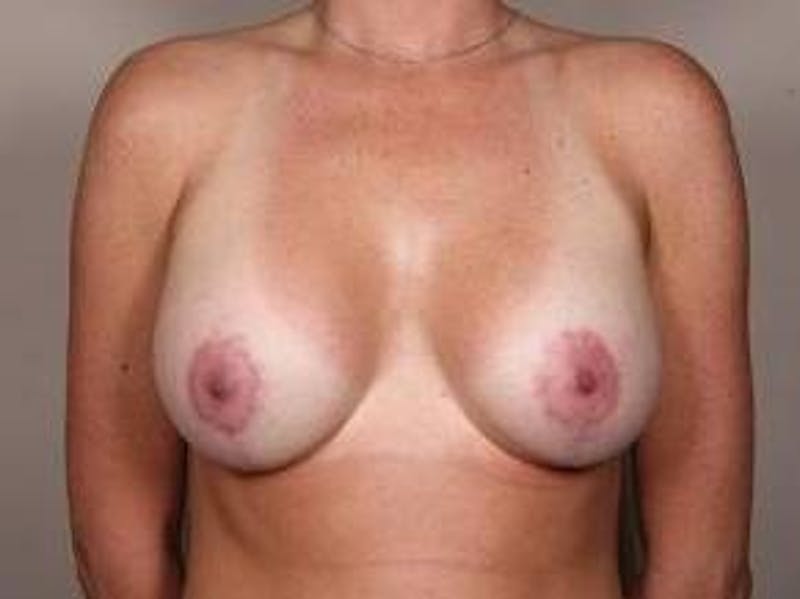Breast Lift with Augmentation Before & After Gallery - Patient 215549 - Image 2 - Scott Chapin, MD