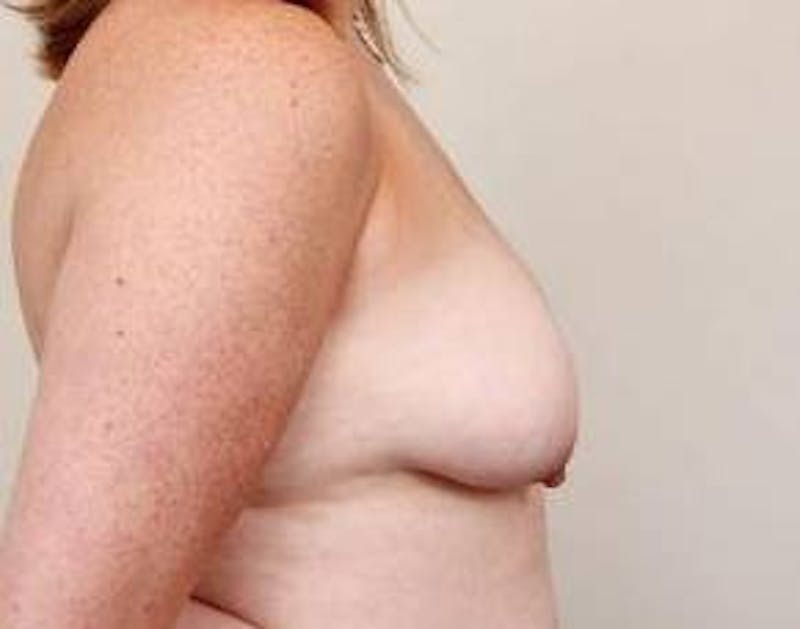 Breast Lift with Augmentation Before & After Gallery - Patient 193987 - Image 5 - Scott Chapin, MD