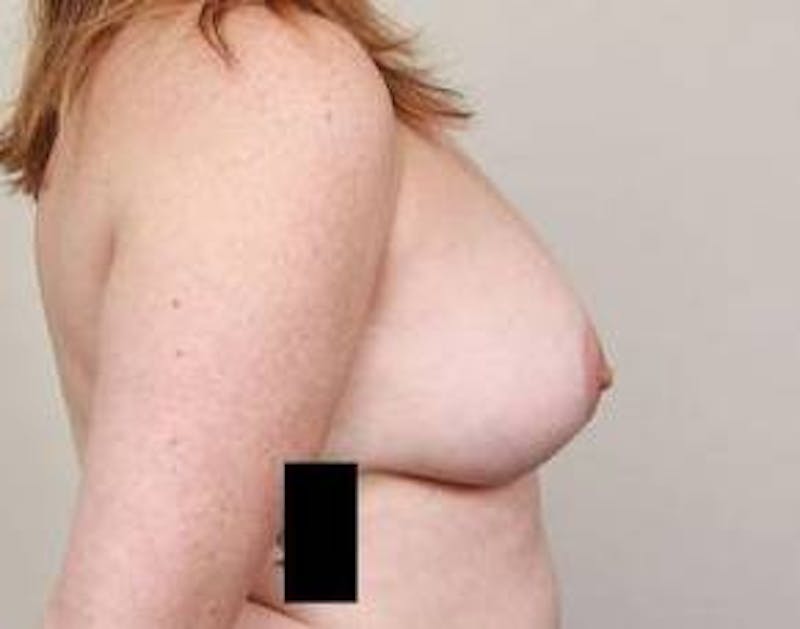 Breast Lift with Augmentation Before & After Gallery - Patient 193987 - Image 6 - Scott Chapin, MD