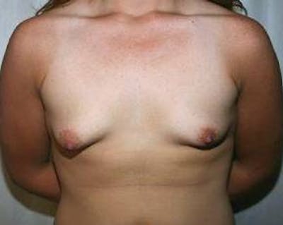 Breast Lift with Augmentation Before & After Gallery - Patient 269049 - Image 1 - Scott Chapin, MD