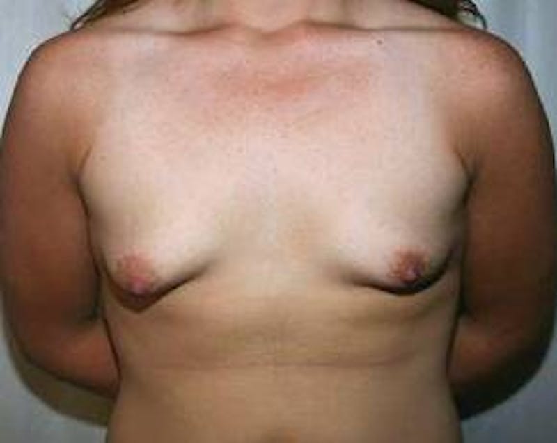 Breast Lift with Augmentation Before & After Gallery - Patient 269049 - Image 1 - Scott Chapin, MD