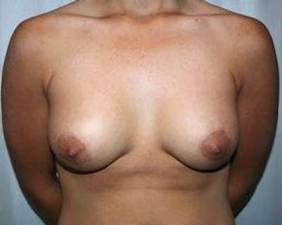 Breast Lift with Augmentation Before & After Gallery - Patient 269049 - Image 2 - Scott Chapin, MD
