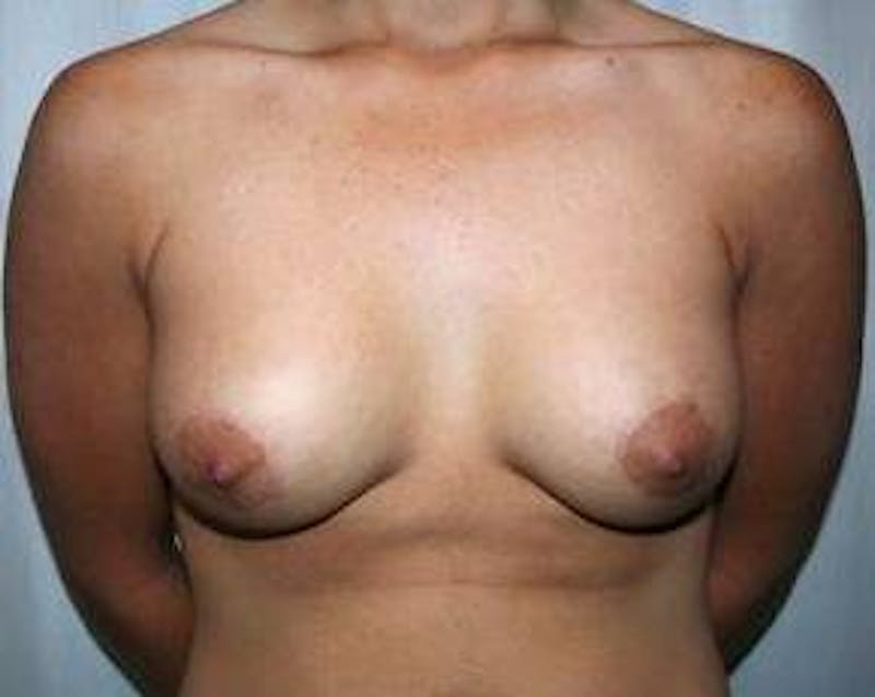Breast Lift with Augmentation Before & After Gallery - Patient 269049 - Image 2 - Scott Chapin, MD