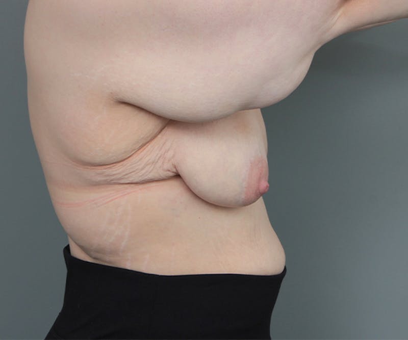Breast Lift Before & After Gallery - Patient 269529 - Image 5 - Scott Chapin, MD