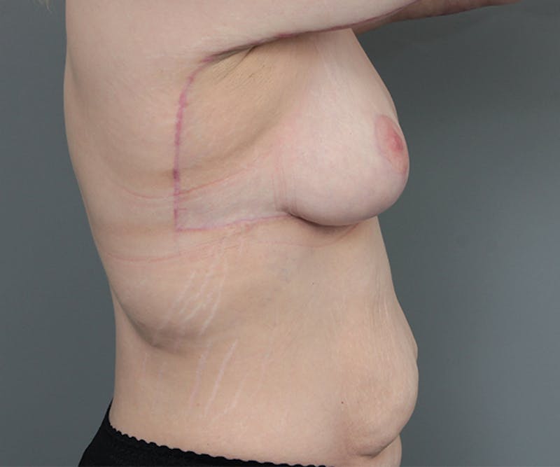 Breast Lift Before & After Gallery - Patient 269529 - Image 6 - Scott Chapin, MD