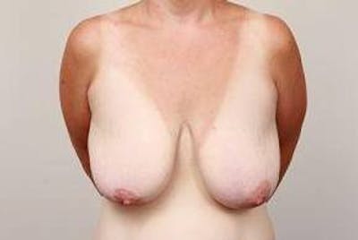 Breast Lift Before & After Gallery - Patient 811171 - Image 1 - Scott Chapin, MD