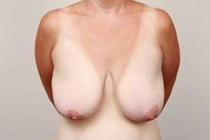 Breast Lift Before & After Gallery - Patient 811171 - Image 1 - Scott Chapin, MD