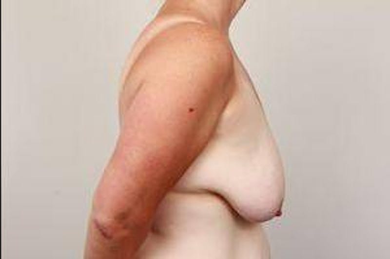Breast Lift Before & After Gallery - Patient 811171 - Image 3 - Scott Chapin, MD