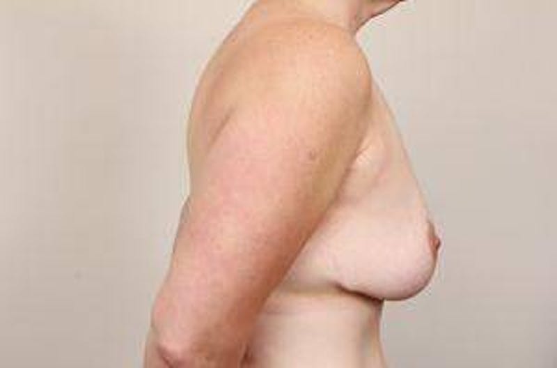 Breast Lift Before & After Gallery - Patient 811171 - Image 4 - Scott Chapin, MD
