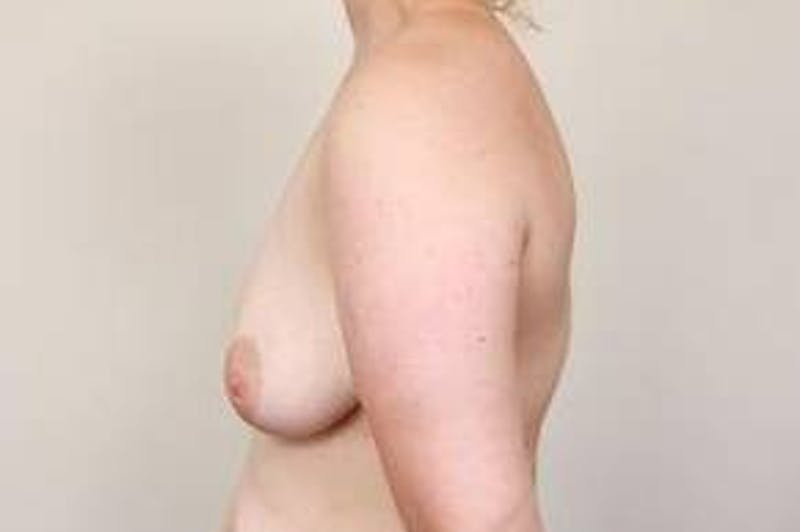 Breast Lift Before & After Gallery - Patient 349231 - Image 3 - Scott Chapin, MD