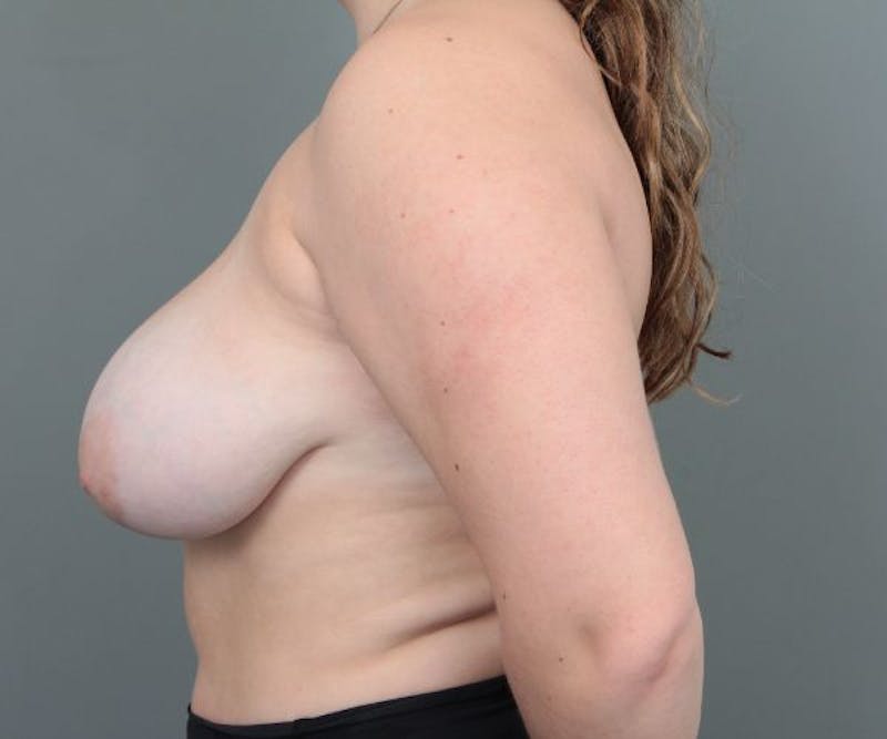 Breast Reduction Before & After Gallery - Patient 368422 - Image 3 - Scott Chapin, MD