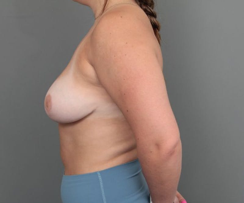 Breast Reduction Before & After Gallery - Patient 368422 - Image 4 - Scott Chapin, MD