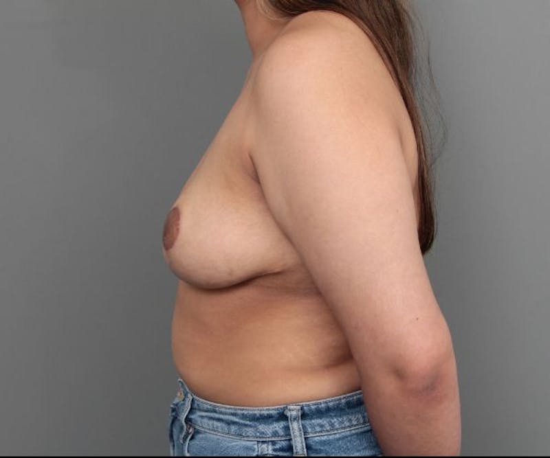 Breast Reduction Before & After Gallery - Patient 144194 - Image 4 - Scott Chapin, MD