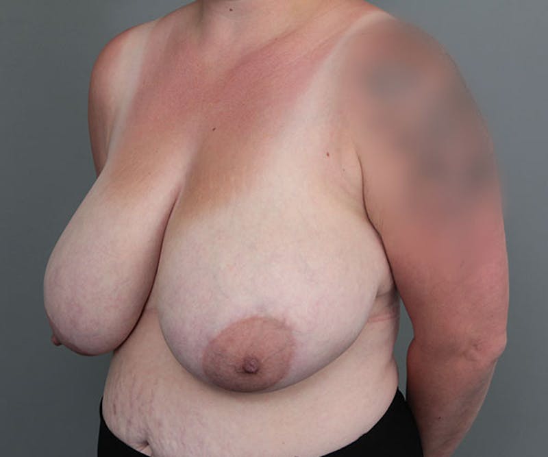 Breast Reduction Before & After Gallery - Patient 365925 - Image 3 - Scott Chapin, MD