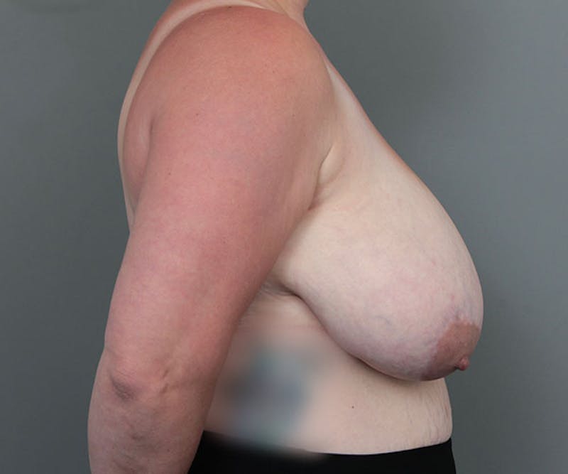 Breast Reduction Before & After Gallery - Patient 365925 - Image 5 - Scott Chapin, MD