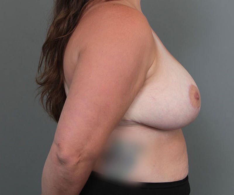 Breast Reduction Before & After Gallery - Patient 365925 - Image 6 - Scott Chapin, MD