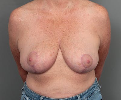 Breast Reduction Before & After Gallery - Patient 248156 - Image 2 - Scott Chapin, MD
