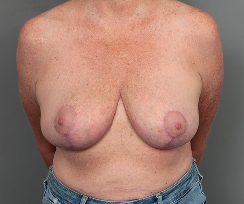 Breast Reduction Before & After Gallery - Patient 248156 - Image 2 - Scott Chapin, MD