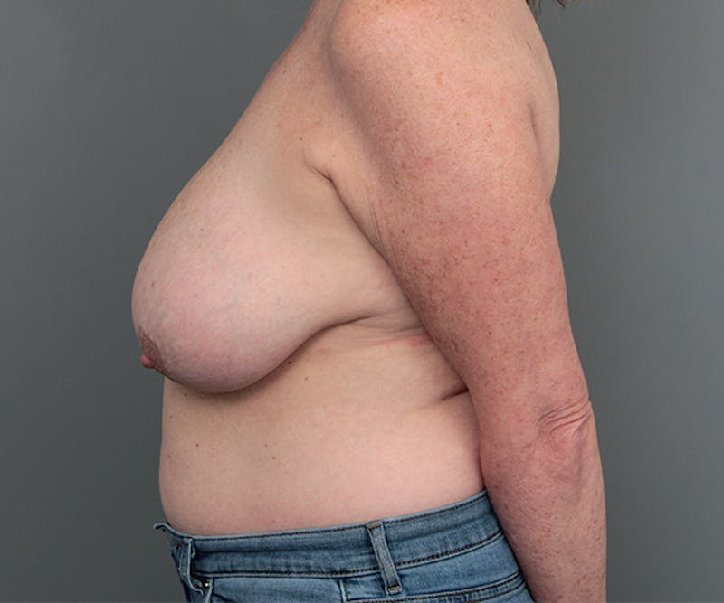 Breast Reduction Before & After Gallery - Patient 248156 - Image 3 - Scott Chapin, MD