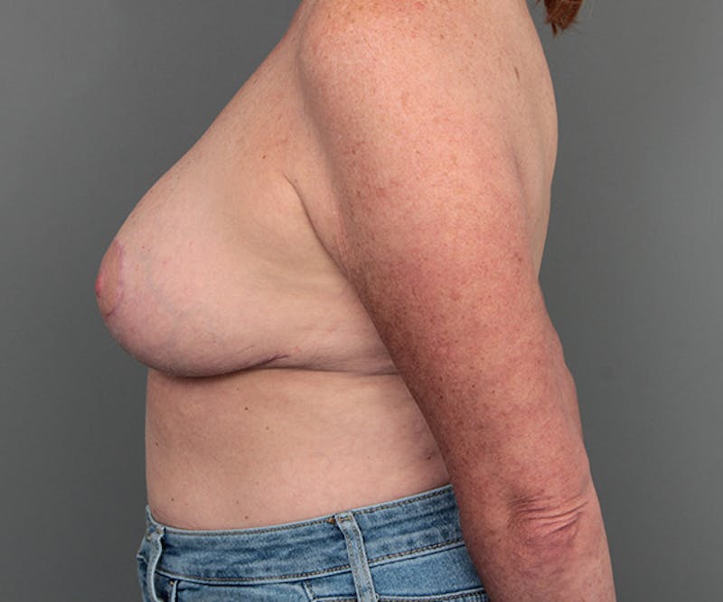 Breast Reduction Before & After Gallery - Patient 248156 - Image 4 - Scott Chapin, MD