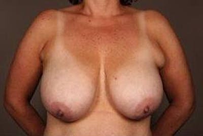 Breast Reduction Before & After Gallery - Patient 378646 - Image 1 - Scott Chapin, MD
