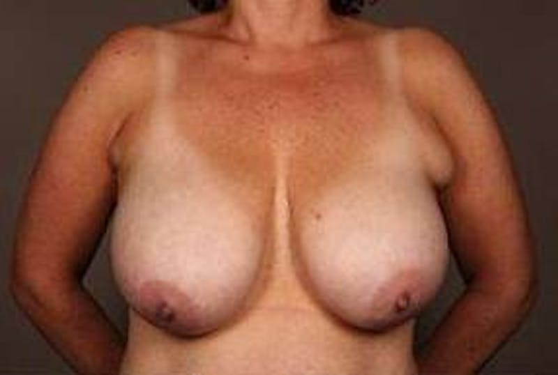 Breast Reduction Before & After Gallery - Patient 378646 - Image 1 - Scott Chapin, MD
