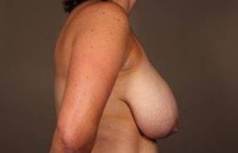 Breast Reduction Before & After Gallery - Patient 378646 - Image 3 - Scott Chapin, MD