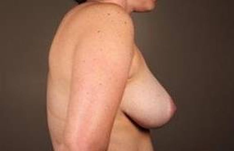 Breast Reduction Before & After Gallery - Patient 378646 - Image 4 - Scott Chapin, MD
