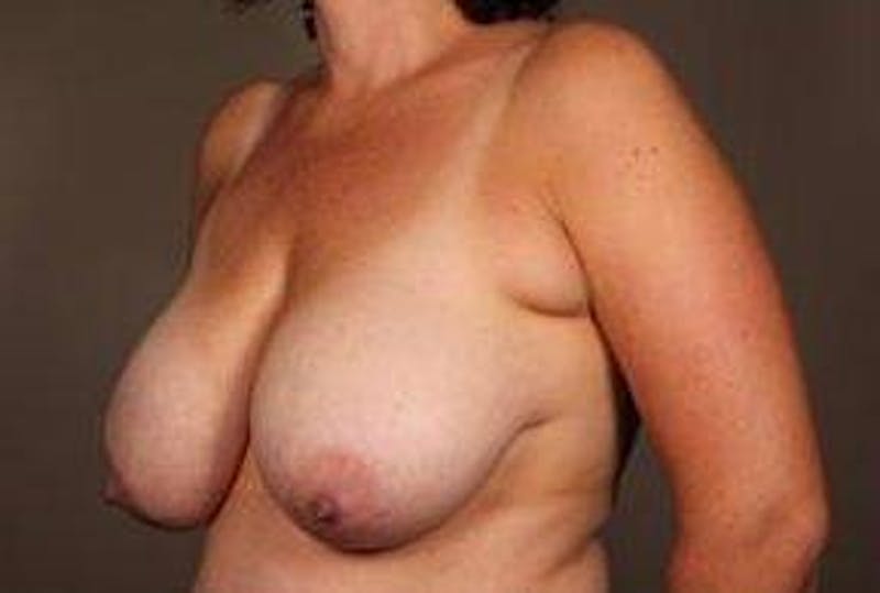 Breast Reduction Before & After Gallery - Patient 378646 - Image 5 - Scott Chapin, MD