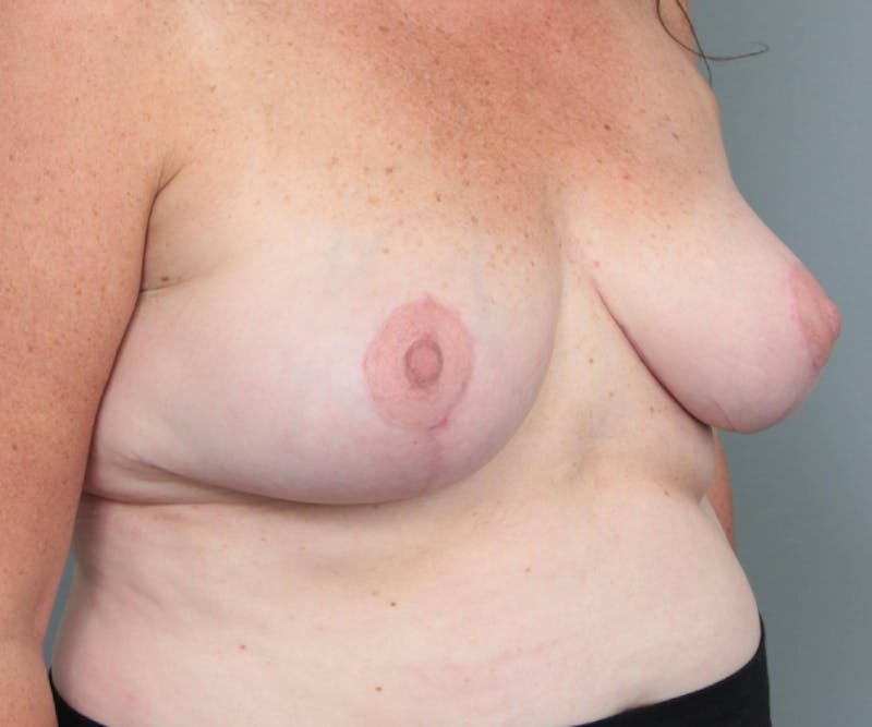 Breast Reduction Before & After Gallery - Patient 132116 - Image 4 - Scott Chapin, MD