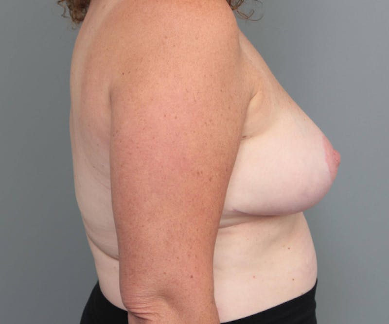 Breast Reduction Before & After Gallery - Patient 132116 - Image 6 - Scott Chapin, MD