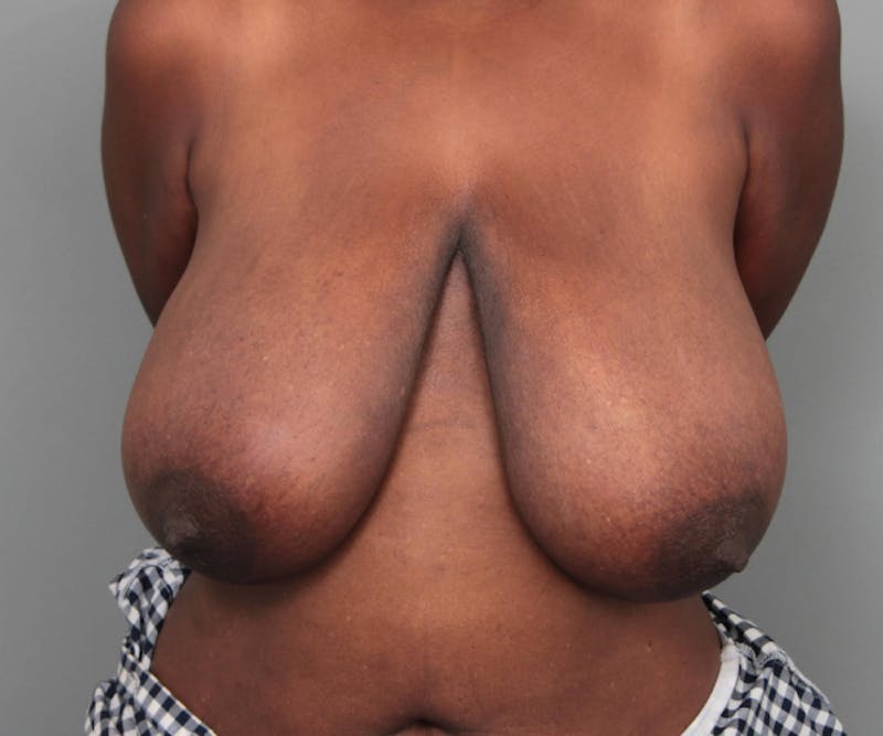 Breast Reduction Before & After Gallery - Patient 314652 - Image 1 - Scott Chapin, MD