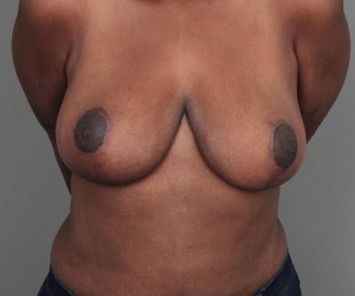 Breast Reduction Before & After Gallery - Patient 314652 - Image 2 - Scott Chapin, MD