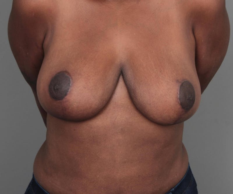 Breast Reduction Before & After Gallery - Patient 314652 - Image 2 - Scott Chapin, MD