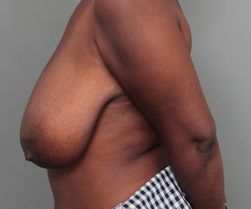 Breast Reduction Before & After Gallery - Patient 314652 - Image 5 - Scott Chapin, MD