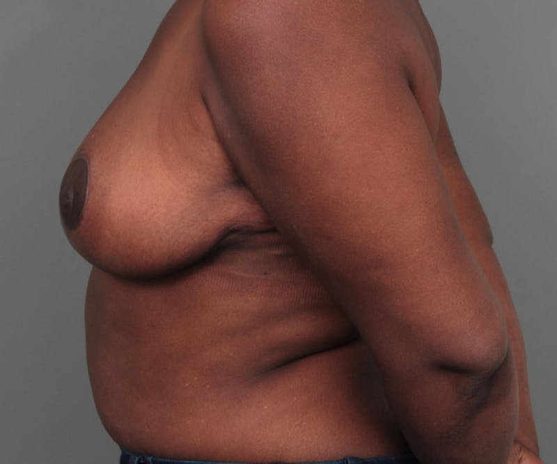 Breast Reduction Before & After Gallery - Patient 314652 - Image 6 - Scott Chapin, MD