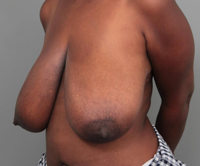 Breast Reduction Before & After Gallery - Patient 314652 - Image 7 - Scott Chapin, MD