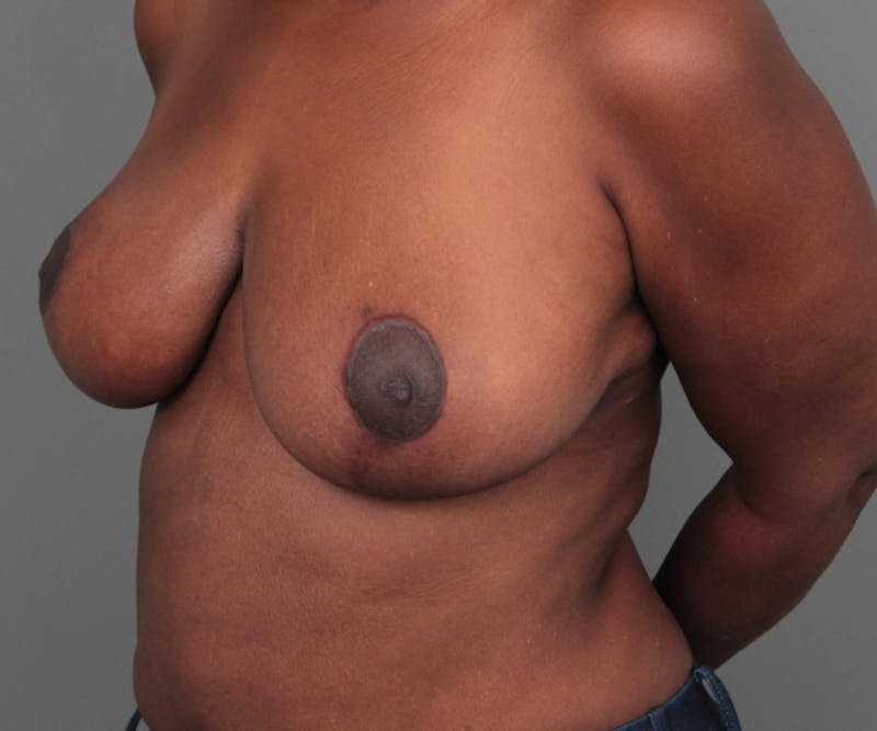 Breast Reduction Before & After Gallery - Patient 314652 - Image 8 - Scott Chapin, MD
