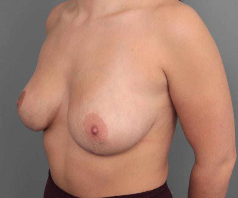 Breast Reduction Before & After Gallery - Patient 143978 - Image 4 - Scott Chapin, MD