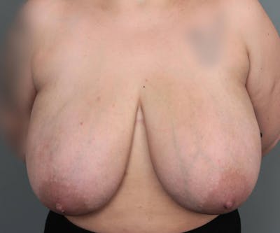 Breast Reduction Before & After Gallery - Patient 362173 - Image 1 - Scott Chapin, MD