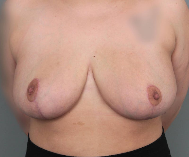 Breast Reduction Before & After Gallery - Patient 362173 - Image 2 - Scott Chapin, MD