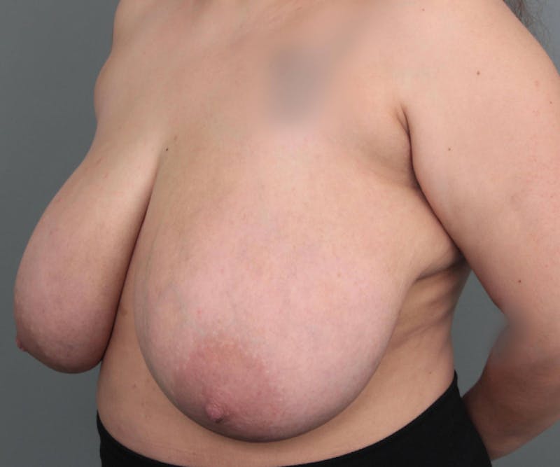 Breast Reduction Before & After Gallery - Patient 362173 - Image 3 - Scott Chapin, MD