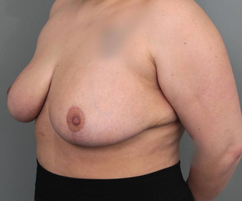 Breast Reduction Before & After Gallery - Patient 362173 - Image 4 - Scott Chapin, MD