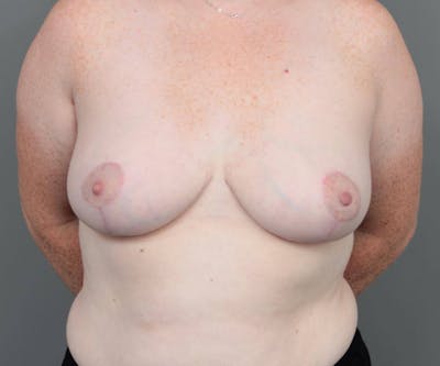 Breast Reduction Before & After Gallery - Patient 151006 - Image 2 - Scott Chapin, MD