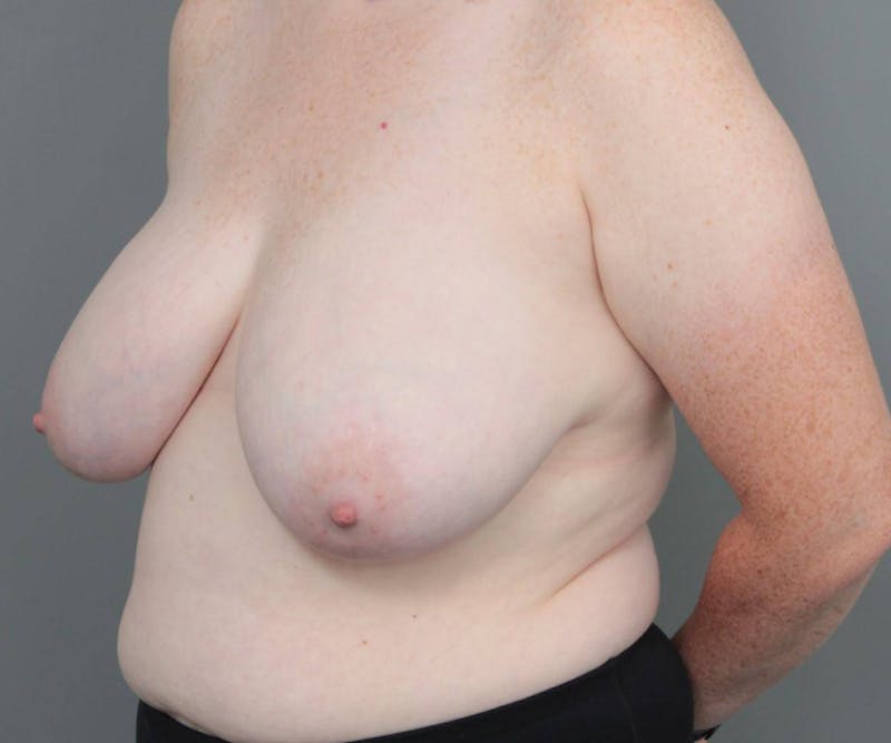 Breast Reduction Before & After Gallery - Patient 151006 - Image 3 - Scott Chapin, MD