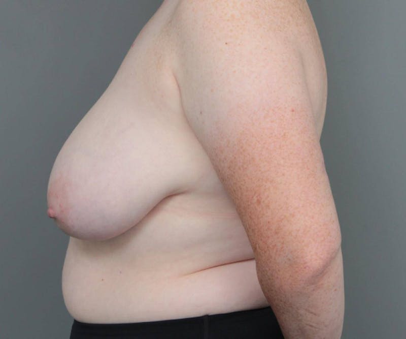 Breast Reduction Before & After Gallery - Patient 151006 - Image 5 - Scott Chapin, MD