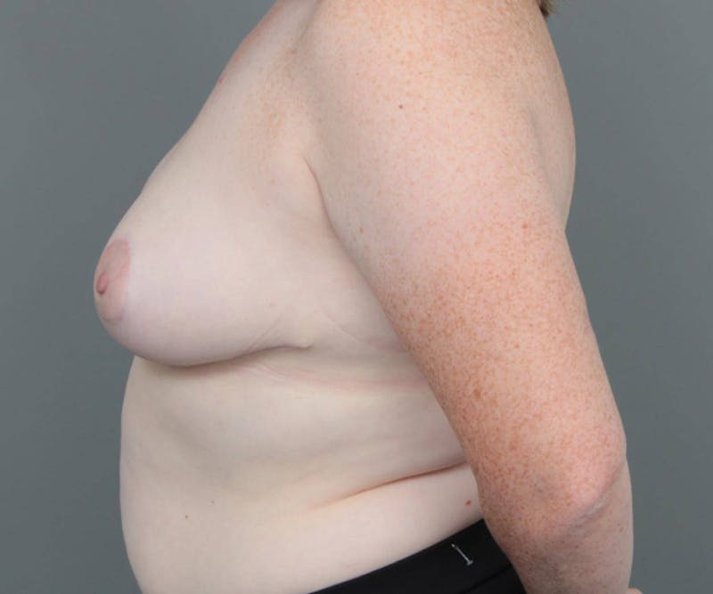 Breast Reduction Before & After Gallery - Patient 151006 - Image 6 - Scott Chapin, MD