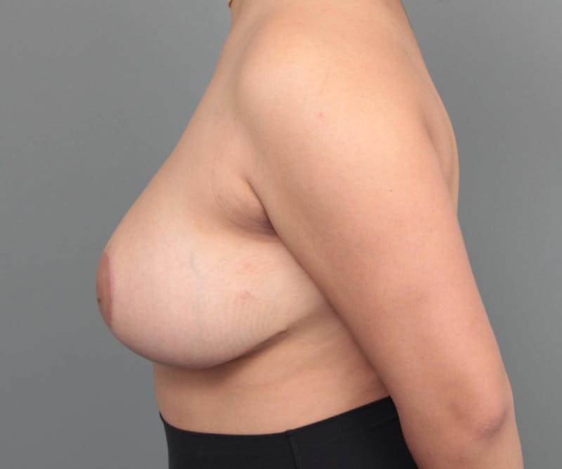 Breast Reduction Before & After Gallery - Patient 256200 - Image 4 - Scott Chapin, MD